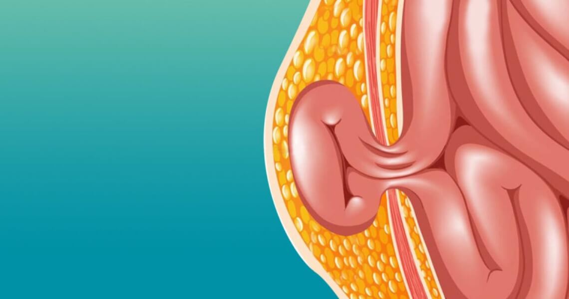 Hérnias da parede abdominal - Distúrbios gastrointestinais